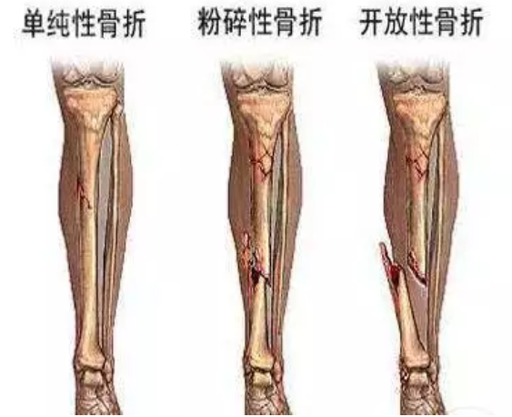 单纯性骨折/粉碎性骨折/开放性骨折
